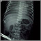 Totally anomalous pulmonary venous return, X-ray