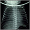 Totally anomalous pulmonary venous return, X-ray