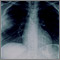 Aspergillosis - chest X-ray