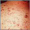 Acne, vulgaris on the back