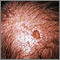 Actinic keratosis on the scalp