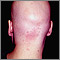 Alopecia total; vista posterior de la cabeza