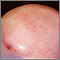 Alopecia totalis - front view of the head