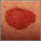 Skin cancer, basal cell carcinoma - spreading