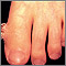 Wart (verruca) with a cutaneous horn on the toe