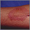 Dermatitis, contact