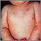 Dermatitis, atopic in an infant