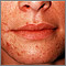 Dermatitis, perioral