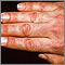 Dermatomyositis, Gottron's papule