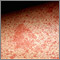 Eczema, atopic - close-up