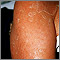 Exfoliation following erythroderma