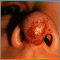 Hemangioma on the face (nose)