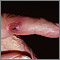 Janeway lesion on the finger