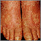 Pityriasis rubra pilaris on the feet