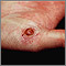 Pyogenic granuloma on the hand