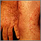 Ringworm, tinea on the hand and leg