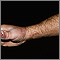 Sporotrichosis on the hand and arm