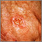 Skin cancer, squamous cell - close-up