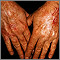 Skin cancer, squamous cell on the hands