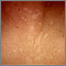 Tinea versicolor - close-up