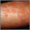 Hives (urticaria) on the arm