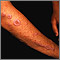 Lichen planus on the arm