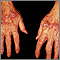 Lichen planus on the hands