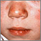 Lupus, discoid on a child's face