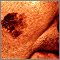 Skin cancer, close-up of lentigo maligna melanoma