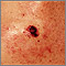 Skin cancer, close-up of level IV melanoma