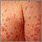 Psoriasis, guttate on the arms and chest