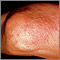 Granuloma, annulare on the elbow