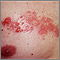 Herpes zoster (shingles) on the chest