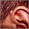 Keloid above the ear