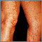 Livedo reticularis on the legs