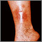 Dermatitis, stasis on the leg