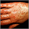 Vasculitis, urticarial on the hand