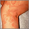 Ringworm, tinea corporis on the leg