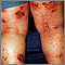 Dermatitis, atopic on the legs