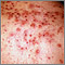 Acne, close-up of cysts on the back