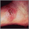 Leishmania panamensis on the foot