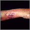 Sporotrichosis on the forearm