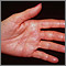 Herpes zoster (shingles) on the hand