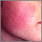 Keratosis pilaris rubra faceii