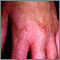 Phytophotodermatitis on the hand