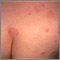 Hives (urticaria) on the back and buttocks