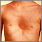 Pectus excavatum