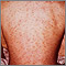 Drug rash on the back