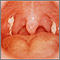 Mononucleosis - view of the throat