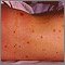 Meningococcal lesions on the back